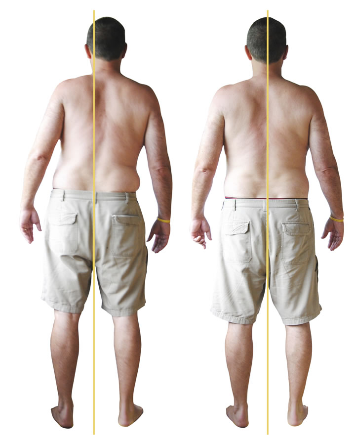 Back Strain client posterior before and after